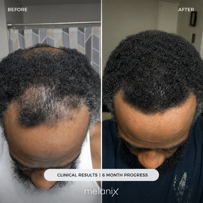 Hair Regrowth Adenosine & GHK-Cu Micro-Infusion System