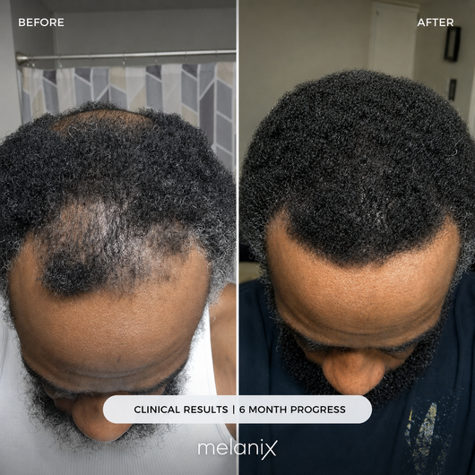 Hair Regrowth Adenosine & GHK-Cu Micro-Infusion System