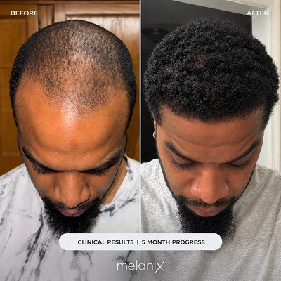Hair Regrowth Adenosine & GHK-Cu Micro-Infusion System