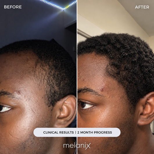 Hair Regrowth Adenosine & GHK-Cu Micro-Infusion System