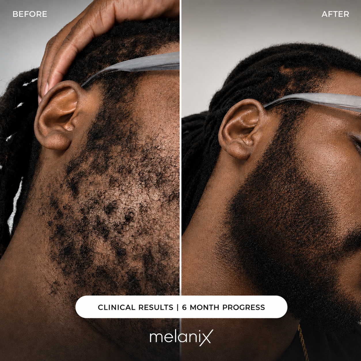 Beard Regrowth Adenosine & GHK-Cu Micro-Infusion System
